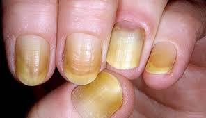 home remes to treat yellow nails