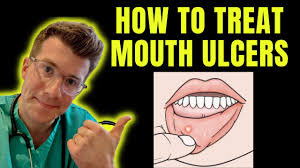 how to recognise and treat mouth ulcers