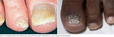 nail fungus disease reference guide