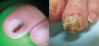 nail disorders clinic dermatology ohsu