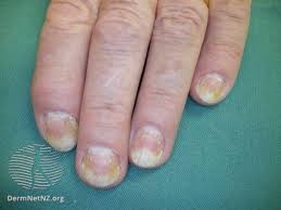 onycholysis causes and treatment