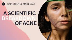 hormonal acne causes treatment