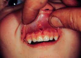upper lip frenulum injuries