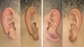 what-causes-earlobe-to-split
