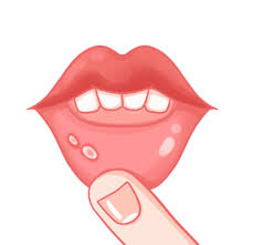 mouth ulcer png transpa images free