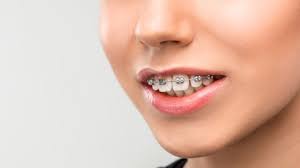 Maybe you would like to learn more about one of these? How To Fix An Overbite Causes Corrections Rome Orthodontics