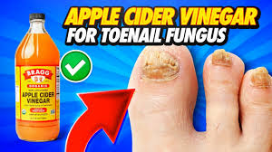 apple cider vinegar for toenail fungus