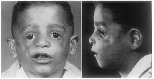 Franceschetti syndrome is an autosomal dominant disorder of craniofacial development with variable expressivity. Https Www Jprasurg Com Article S0007 1226 64 80020 5 Pdf