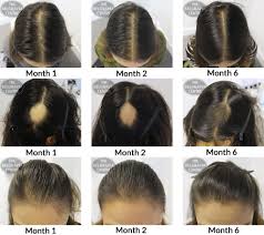 The front hairline remains unaffected except for normal recession. Important Inspiration 28 Short Haircuts For Female Pattern Baldness