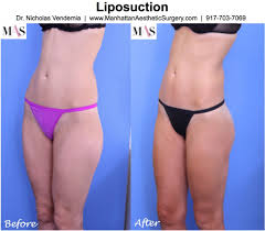 laser liposuction new york city dr