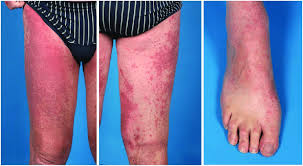 appearance of ulative skin toxicity