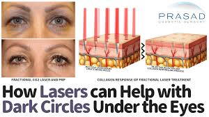 laser treatment for dark circles under