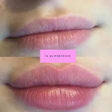 Needle free lip filler | Lip fillers, Dermal fillers lips, Facial fillers