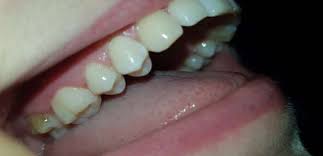 Was ist mit meinem Zahn falsch? (Gesundheit und Medizin, Zähne, Zahnspange)