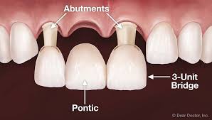 dental bridges northwest dental