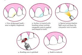 For example, veneers are usually not covered by insurance. Everything You Need To Know About Dental Bonding Treatment