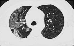 Cureus Chest Ct Findings And Their