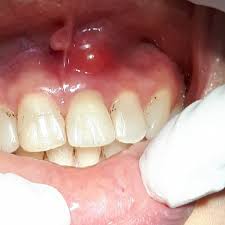 tooth abscess symptoms causes and