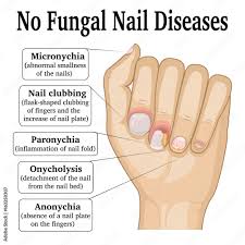 no fungal nail disease stock vector