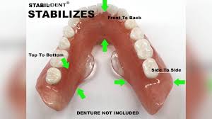 lower denture ilizer kit