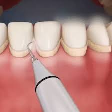 DentiCare™ - Ultrasonic Dental Scaler – Sunsdale | Dental, Teeth, Perfect  teeth
