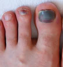 black bruised toenail bleeding