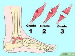 4 ways to treat a sprained ankle wikihow