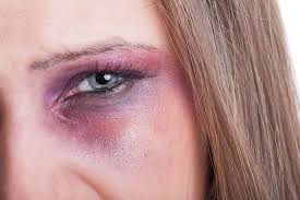 5 ways to relieve a black eye naturally