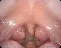tonsil tonsil surgery tonsillectomy