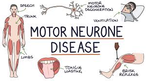 understanding motor neurone disease
