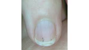 what s causing that black line on your nail