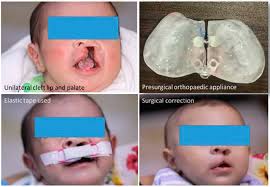 pas of children with cleft lip