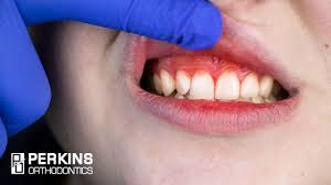 gum disease while wearing braces