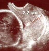 short cervix in pregnancy