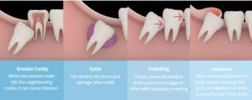 wisdom tooth extraction removal in