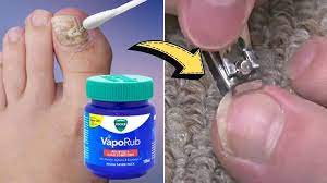 treat toenail fungus with vicks vaporub