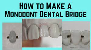 how to make a monodont dental bridge