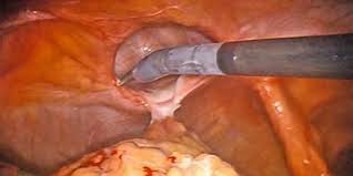 gallbladder surgery