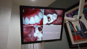 Kakitangan pihak berkuasa tempatan dan badan. Pengalaman Scalling Gigi Di Klinik Pergigian Qaseh Dental Mek Onie