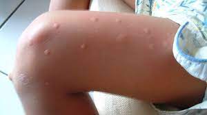 bed bug bites vs mosquito bites