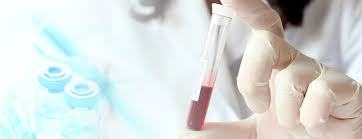 Serum free hemoglobin test, checking for HB level