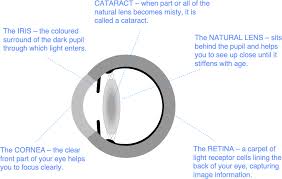 refractive lens exchange rle