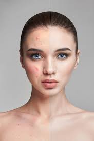 acne scars and large pores explained