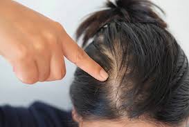 hair loss women how to deal with hair