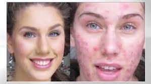 acne scarred model undergoes