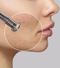 microdermabrasion for acne scars