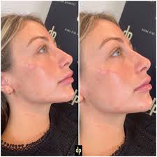 This gives you a tight jaw line and a fresh look. Jawline Fillers Derma Plus Aesthetics