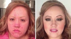 12 acne before and after makeovers