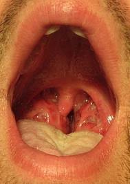 peritonsillar abscess causes symptoms