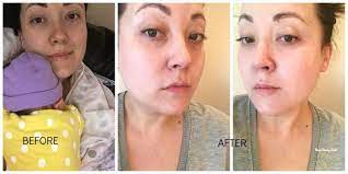 Check out the effect of peels and microdermabrasion in these amazing before and after photos here at new radiance of wellington. At Home Spa Treatment With Trophy Skin Microdermmd Steemit